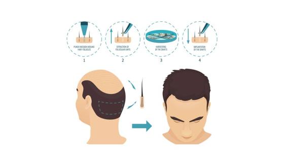 الأمور المتعلقة بمرحلة ما بعد إجراء زراعة الشعر في تركيا